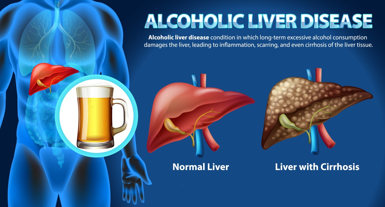 How Alcohol Affects Liver Health